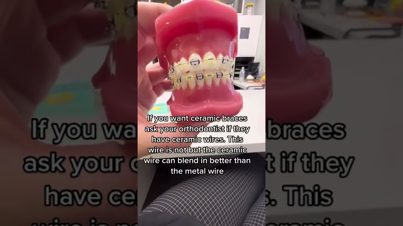 Ceramic wires are a great option! Not every orthodontist Carries them so make sure you ask these qu