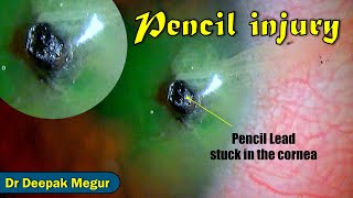 Pencil Injury to the eye . Pencil Lead Stuck inside..! Tips to remove the FB - Dr Deepak Megur