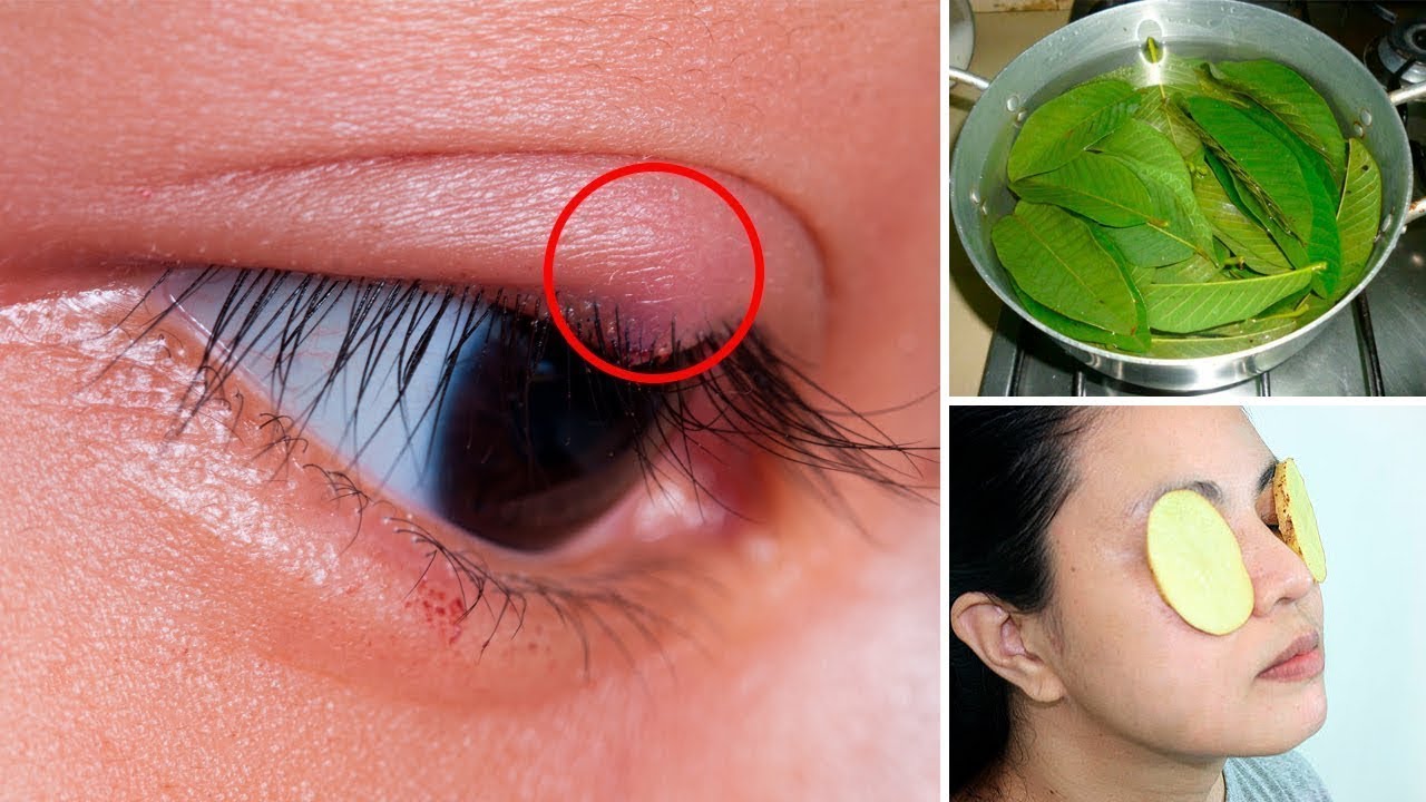 How to Get Rid of a Sty (Stye) 4 Effective Home Remedies YouTube