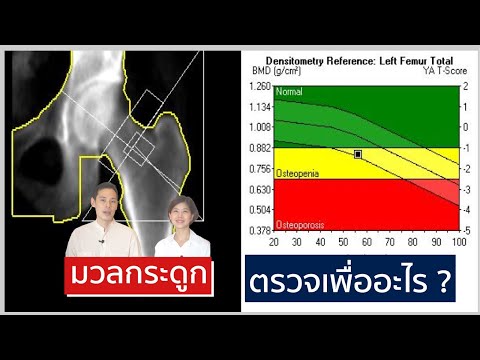 ตรวจมวลกระดูก กระดูกบาง กระดูกพรุน  (BMD Scan) ตรวจรักษา ยังไง| EasyDoc Family Talk EP.20