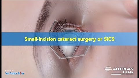 Small Incision Cataract Surgery (SICS)