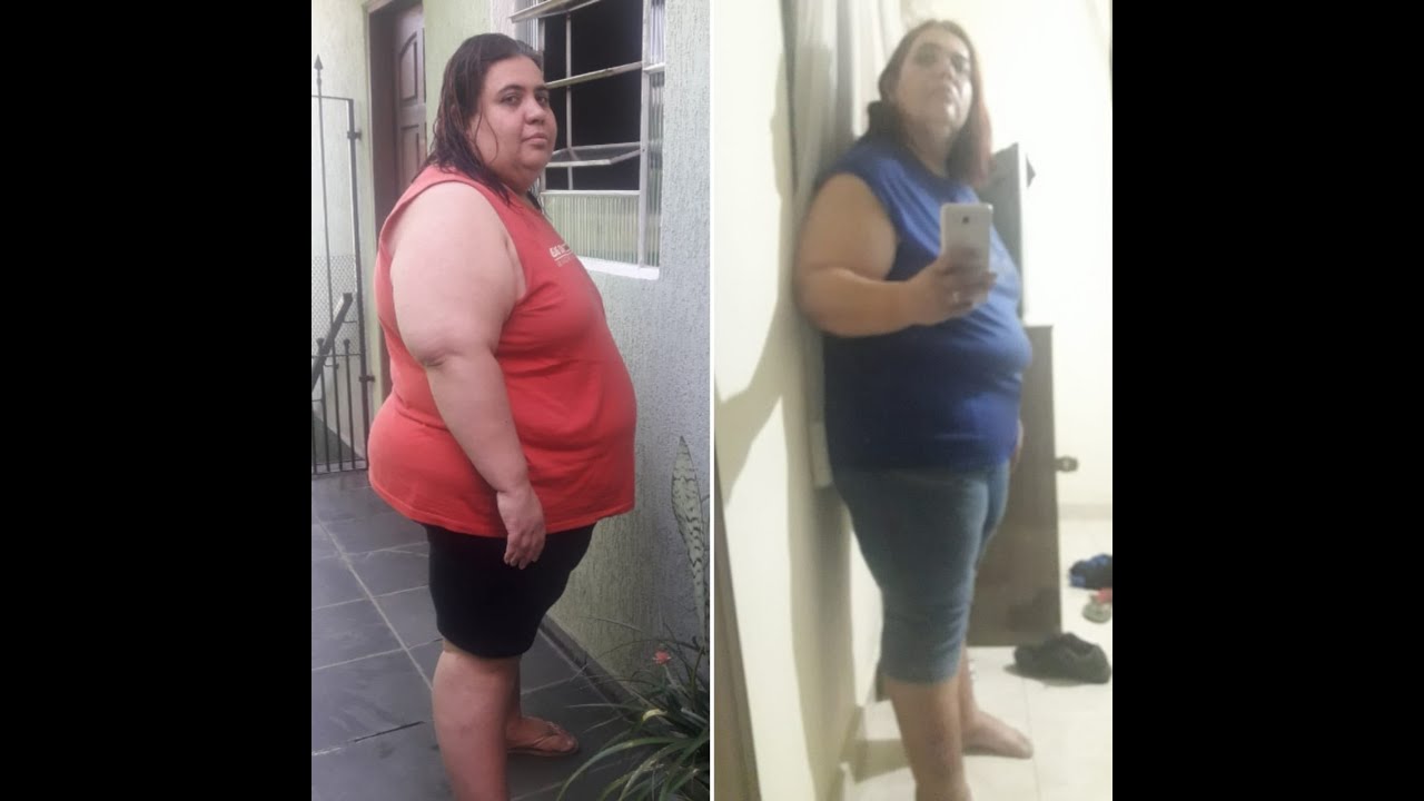 Bariátrica, o antes e o depois, sera que vale apena?