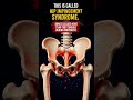 Hip Pain in Your 20s? It Might Not Be What You Think #physicaltherapy #healthtips #physiotherapist