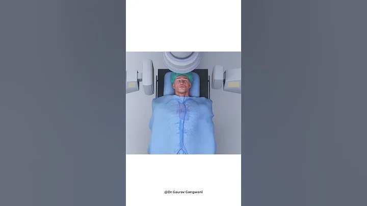 Brain stroke treatment 3D animation | Mechanical thrombectomy | Dr. Gaurav Gangwani