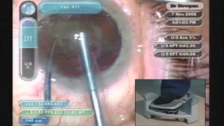 Los Angeles Cataract Surgeon Uday Devgan MD Crystalens Live Surgery at 2008 AAO