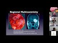 Skull base meningioma neurosurgicaltv