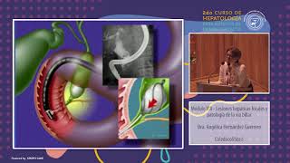 Modulo VIII - Coledocolitiasis