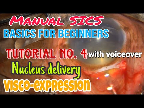 #143 Manual SICS for beginners: Basics of Viscoexpression & vectis assisted nucleus delivery