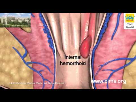 Hemorrhoidectomy (Gujarati) - CIMS Hospital