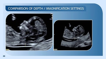 Measuring Nuchal Translucency and Crown Rump Length: 12–13 weeks scan