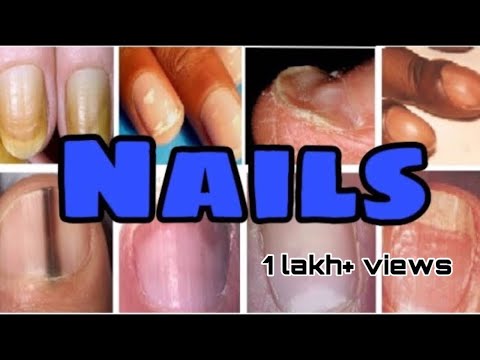 Nails disorders , Nails diseases and differential diagnosis || Mis.Medicine