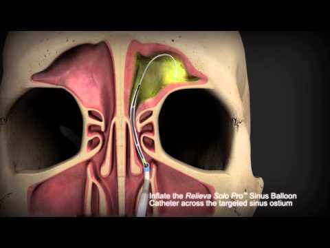 Balloon Sinuplasty Procedure Animation Youtube