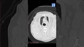 米地のCT読影　肺の孤立性病変