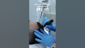 Exosome Hair Treatment and RESULTS