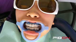 Sebaris White - Laser Teeth Whitening