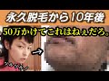 【永久脱毛10年後】光、レーザー脱毛50万。髭は生えてくるのか？