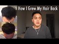 How I Grew My Hair Back  | My Hair Loss Journey and Treatment