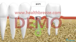 [시연용] c0150aako_아래턱 구치부 임플란트 식립안내 (1단계수술)