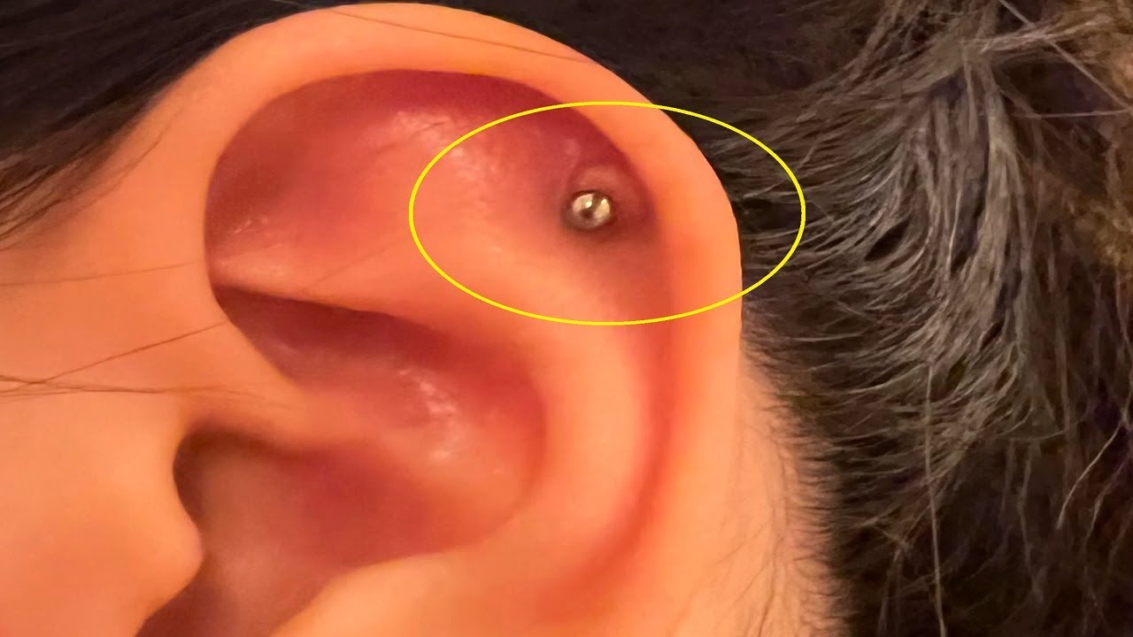 How To Get Rid Of Piercing Bumps On Ear Overnight Youtube 