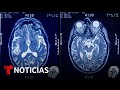Expertos nos advierten qué hacer para evitar el riesgo de demencia | Noticias Telemundo