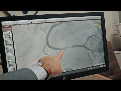 ضيق شديد في الشريان الأيمن وازاي بتعامل معاه بالقسطرة