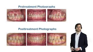 Nonsurgical treatment of an adult with skeletal Class III malocclusion, anterior crossbite, and an