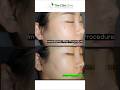 Clim Clinic, BEFORE AFTER Treatments for FLAT WARTS!!