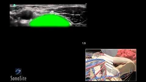 How To: Ultrasound Guided Femoral Nerve Block 3D Video