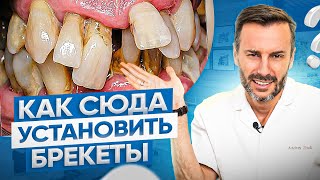 Установка брекетов на кривые зубы у реального пациента клиники OrthoLike | Макросъемка