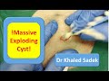 Massive 20 year cyst explosion lipomacystcom dr khaled sadek