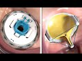 Mitral valve replacement technology  3d animation