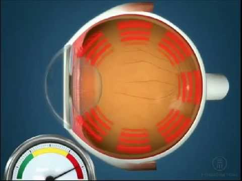 Глазная гипертензия