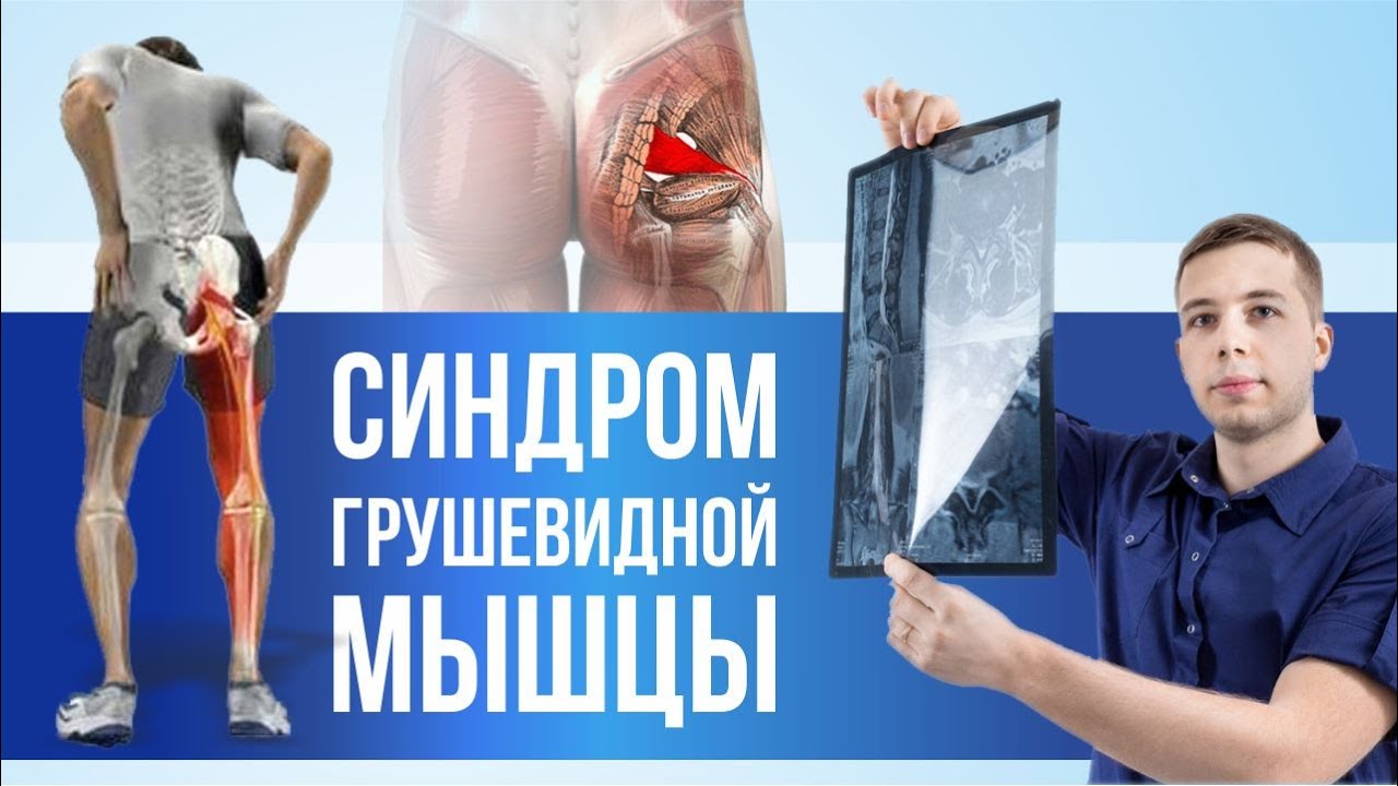 ГРУШЕВИДНАЯ МЫШЦА (синдром) - самое полное видео на Ютуб. Лечение, упражнения, блокада