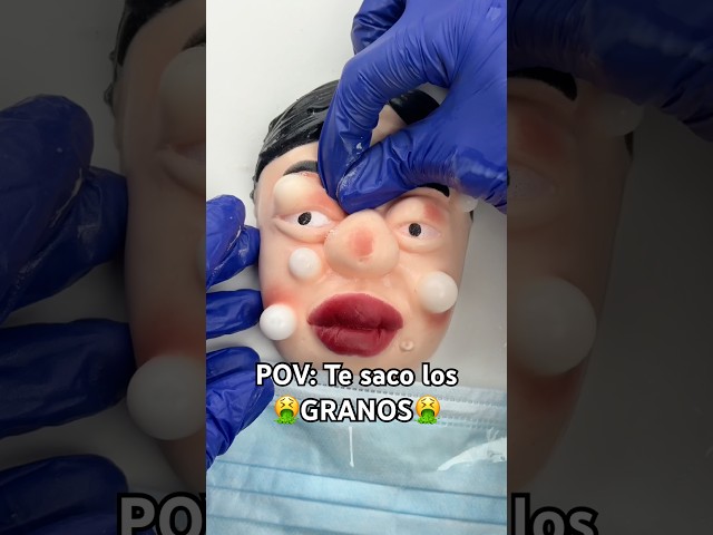 No hay nada MÁS SATISFACTORIO 🫠💉 dios… #satisfying #pimplepopping #juguete #asmrvideos #shorts