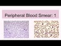 Peripheral Blood Film: 1