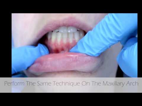 Measuring for Minimally Attached Gingiva