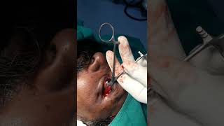 Lateral canthotomy - Dr. Murali Chand