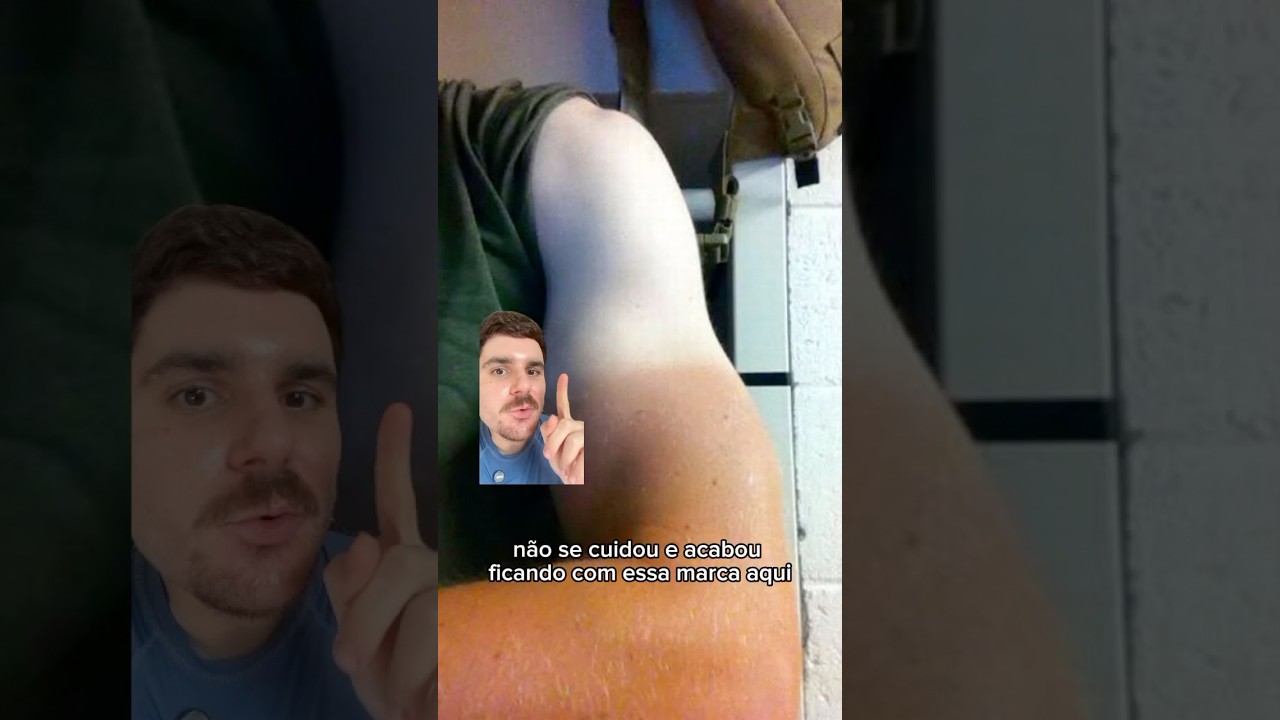 Como remover o bronzeado indesejado 