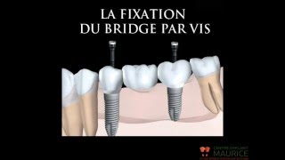 La fixation du bridge par vis - Centre Implant Maurice