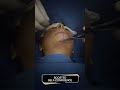 Chin implant by dr adarsh tripathi