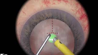 EyeSi CAT C Phaco Chopping Training, Level 3 (full nucleus, horizontal chopper)
