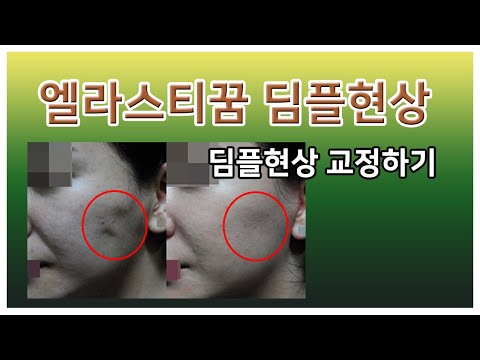 엘라스티꿈 등 실리프팅 부작용인 딤플현상 교정하기 feat.전후사진 (before and after /face lift /Forehead Lift)