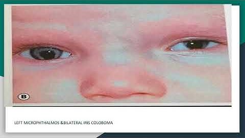 Microphthalmos