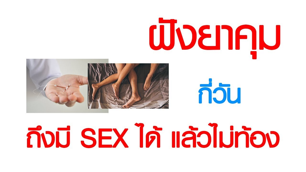 พบหมอเสรี ตอนที่ 374 : ฝังยาคุม กี่วัน ถึงมี SEX ได้ แบบไม่มีโอกาสท้อง