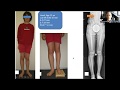 New Strategies for Limb Lengthening & Reconstruction in Russell Silver Syndrome