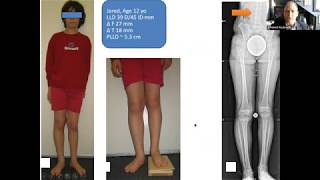 New Strategies for Limb Lengthening & Reconstruction in Russell Silver Syndrome screenshot 5