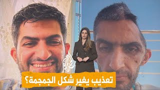 شبكات | صورة مرعبة لجمجمة صحفي فلسطيني بعد خروجه من السجن