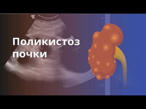 Поликистоз почек. Причина, диагностика и лечение. Критерии УЗИ