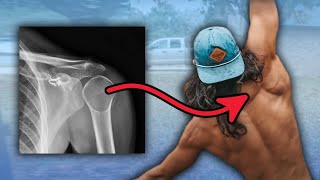 How I Fixed my Shoulder Dislocations & Pain