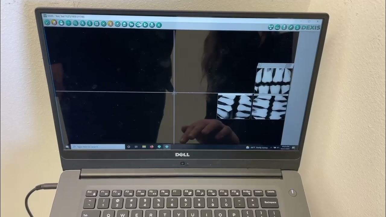 Hiding Radiographs on Dexis YouTube